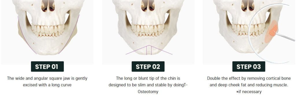 Procedure Process of V-Line Surgery Korea