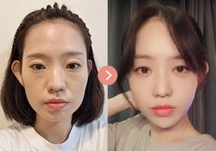 before after facelift korea