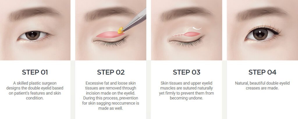 Process of incision double eyelid surgery korea