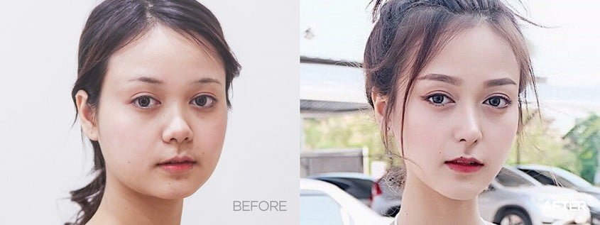 rhinoplasty korea before and after
