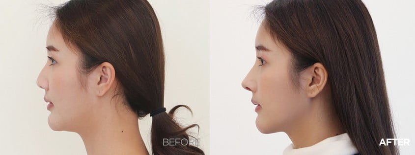 rhinoplasty korea before and after