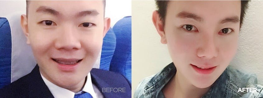rhinoplasty korea before and after