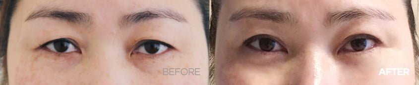 before after upper blepharoplasty korea