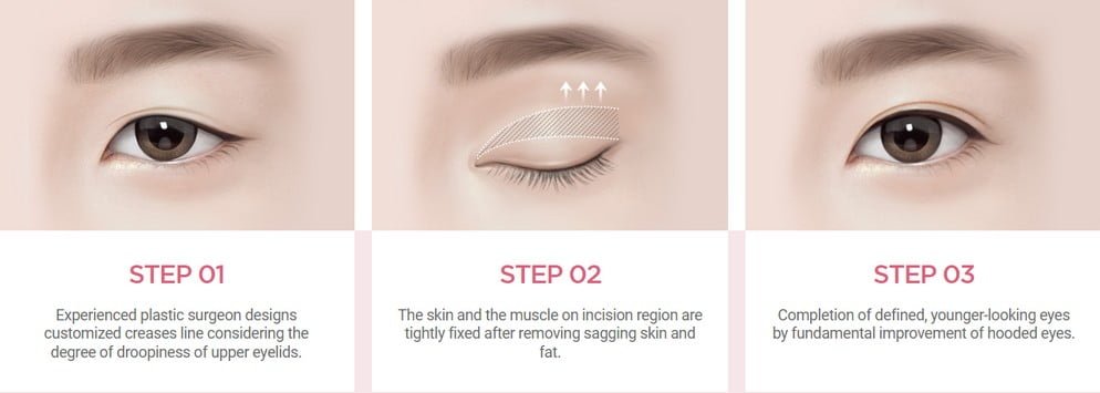surgery process of upper blepharoplasty korea