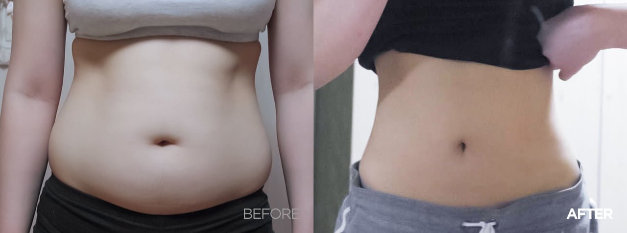 before after korean liposuction