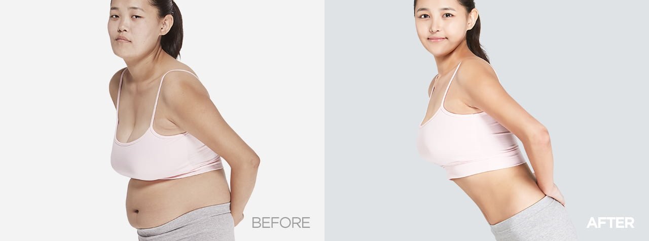 before after liposuction korea