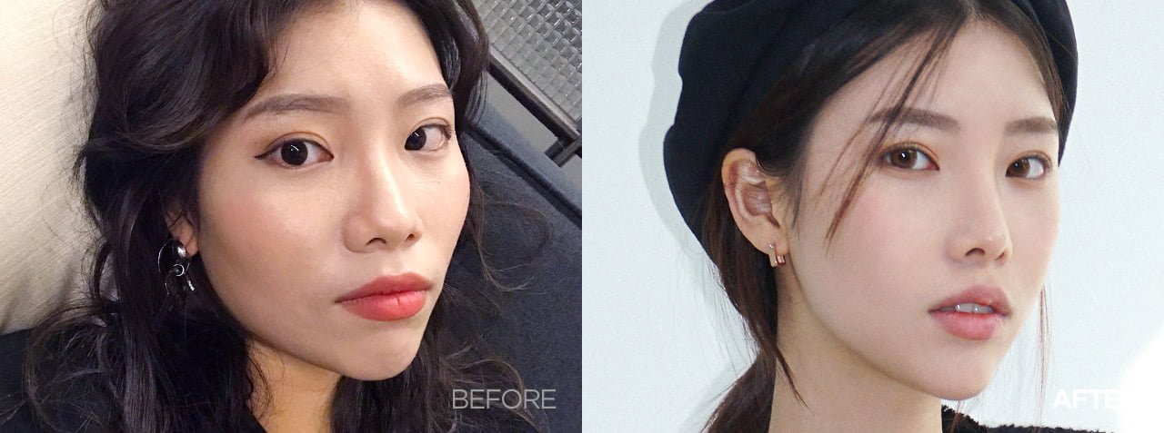 before-after-alarplasty-korea-1