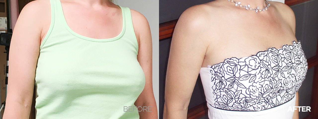 before after breast lift korea