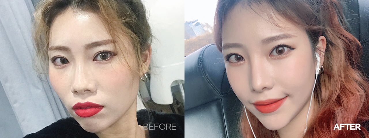 Before after chin reduction surgery korea