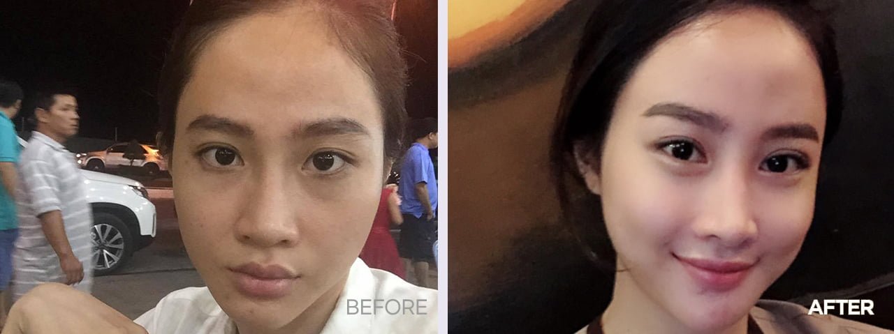 before after fat grafting korea