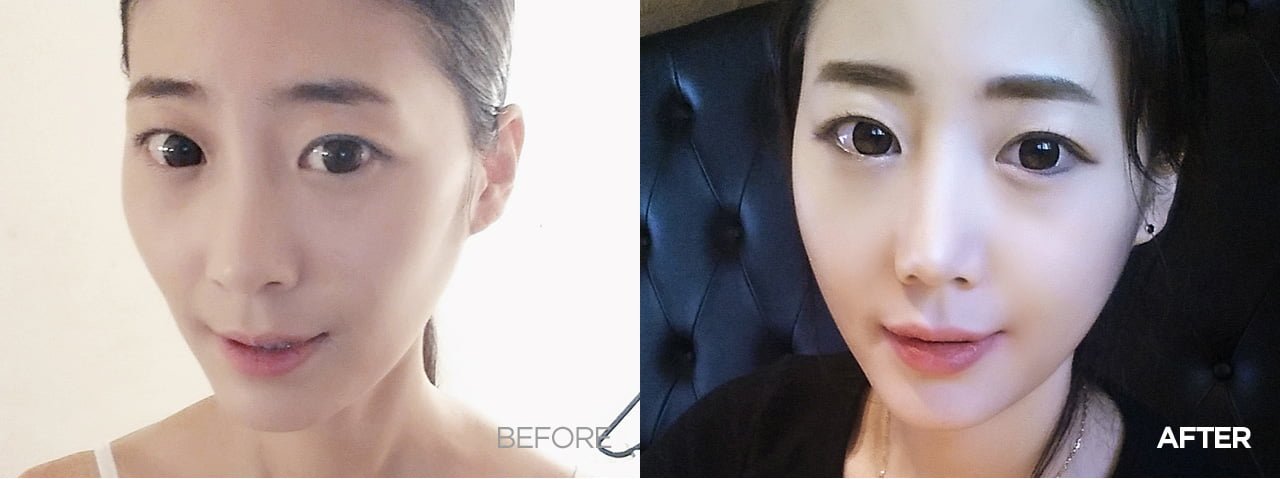 before after fat grafting korea