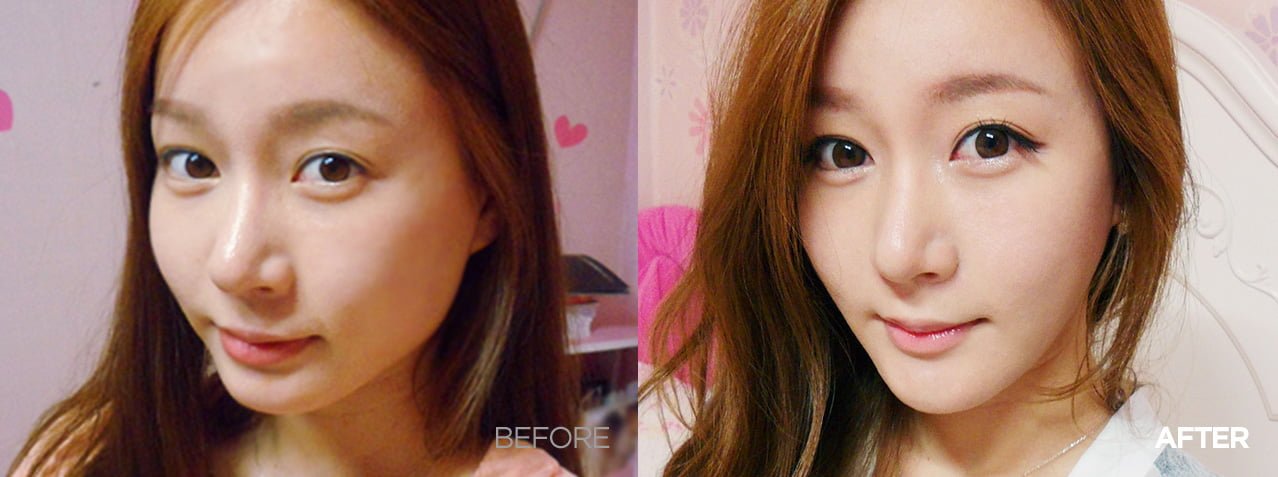 Before after genioplasty korea