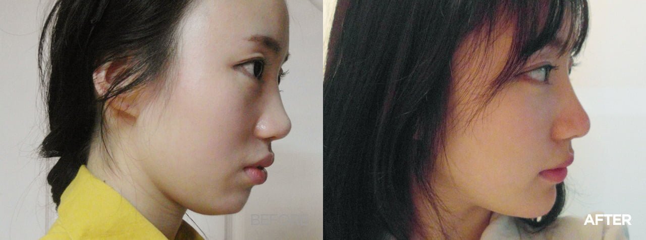Before after genioplasty korea
