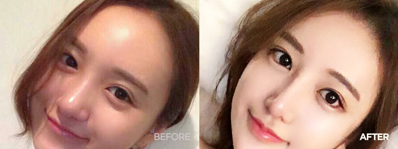 before after hair transplant korea