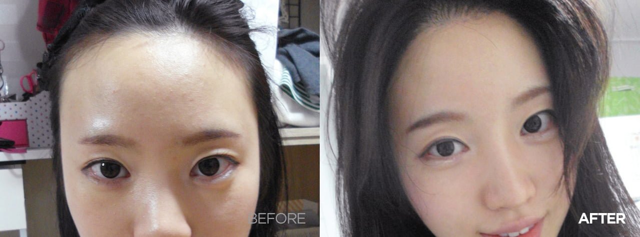 before after hair transplantation korea