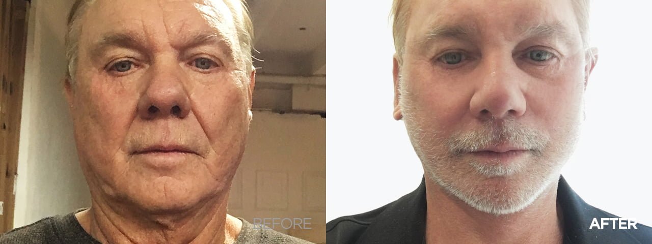 before after smas facelift korea