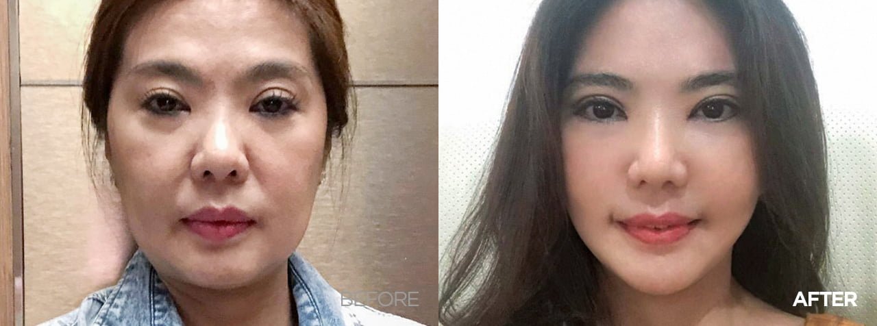 before after smas facelift korea