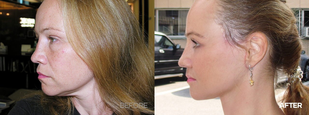 before after smas facelift korea