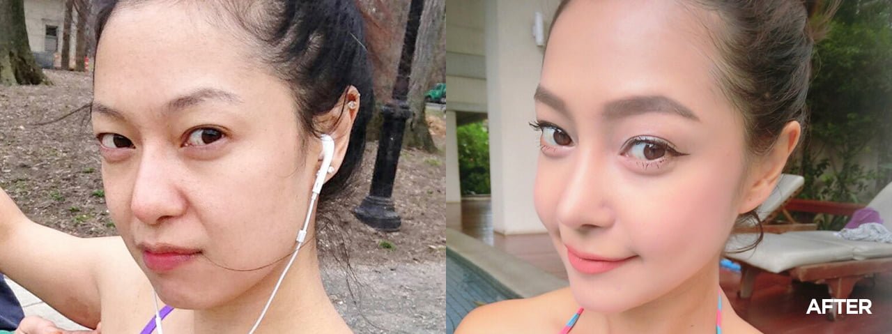 Before after thread lift korea