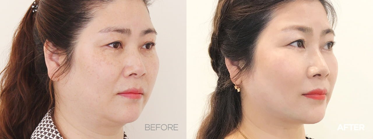 Before after thread lift korea