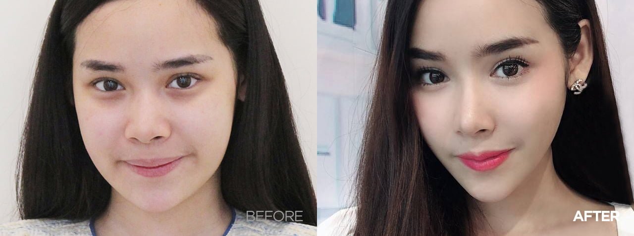 Before after thread lift korea