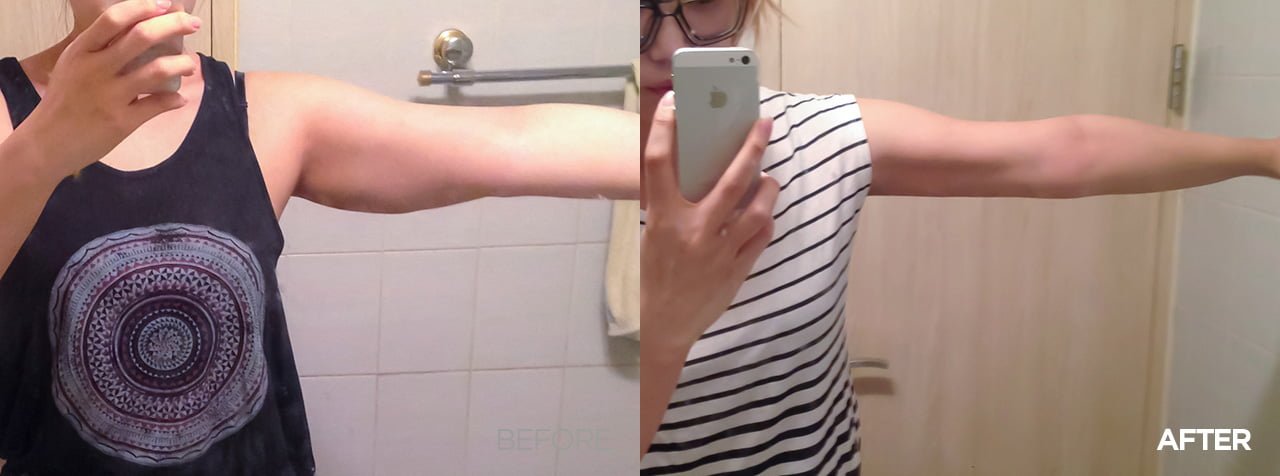 before after liposuction surgery in korea