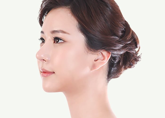 chin reduction korea