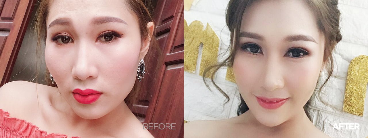 Forehead Lift Korea